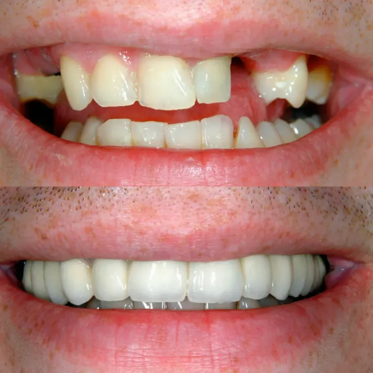 Dente ausente e desgaste generalizado na arcada superior, reabilitados com implantes e próteses.